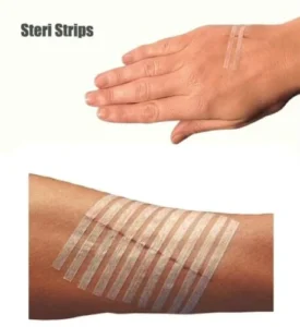 Absorbent Steri Strip Skin Closure Strips to Close Wound
