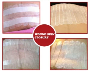 Adhesive Skin Laceration Closures Strip Nonwoven Fabric Minor Cuts Breathable Steri Strips CE Certified Sterile Packaging Class