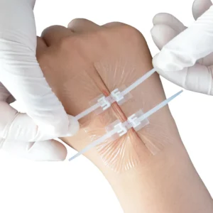 Disposable Suture Free Medical Devices Closure Stitching Stapler Zip Wound Strip Reinforced Non invasive Adhesive Wound Skin