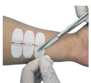 Disposable Zipstitch Zip CNon Invasive Wound Closure Devie Transparent Non Stitch Wound Dressings