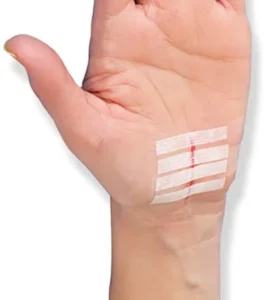 Emergency Steri Strips Wound Closure Kit CE Certified EO Sterilized Single Use Surgical Care Laceration Repair Stitches Fast
