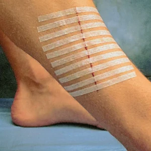 Hospital Surgical Sterile Wound Closure Strips Steri Strip Tape for Skin Closure