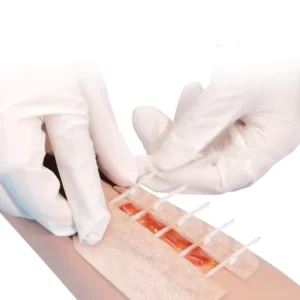 Hydrocolloid Steri Strips Closure Device Non Invasive Zip Tie Sutures with Adhesive Non Invasive Zip Tie Suture Closure
