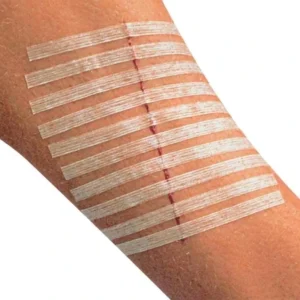 Hypoallergenic Medical Grade Sterilized Skin Closure Strips for Gentle Laceration Repair Post Surgical Wound Care