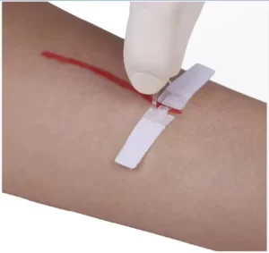 Self Adhesive Disposable Wound Dressings for Skin Closure Suturing Device CE Certified Hospital Use Nonwovens & Plastics